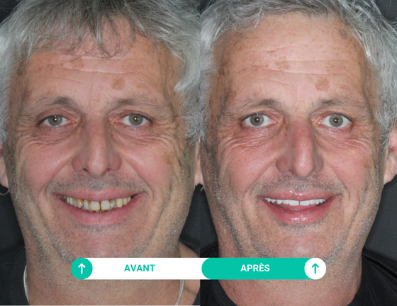 sourire avant apres