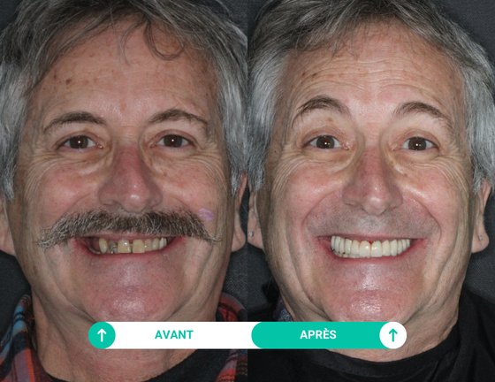 sourire avant apres