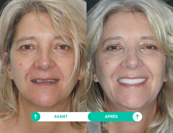 sourire avant apres