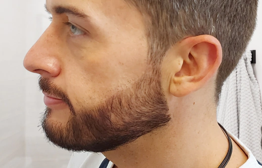 patient greffe barbe