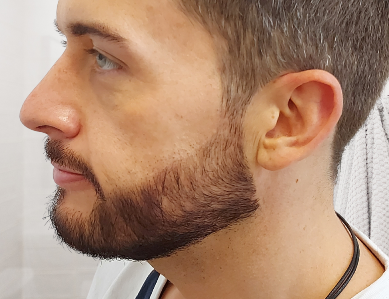 patient greffe barbe