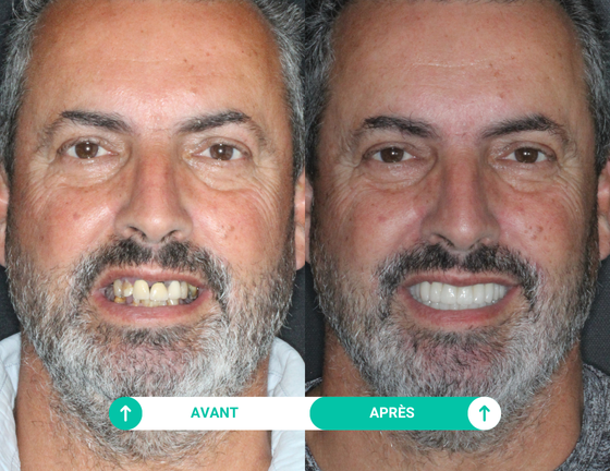 sourire avant apres