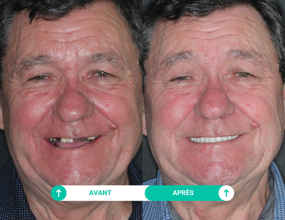 sourire avant apres