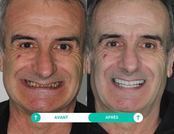 sourire avant apres