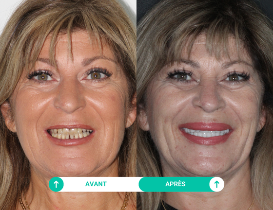 sourire avant apres