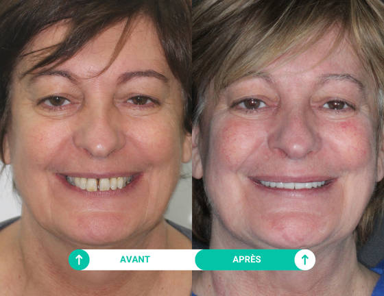sourire avant apres