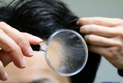 perte de cheveux homme