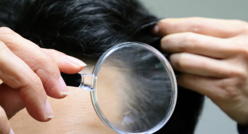 perte de cheveux homme