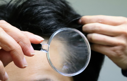 perte de cheveux homme