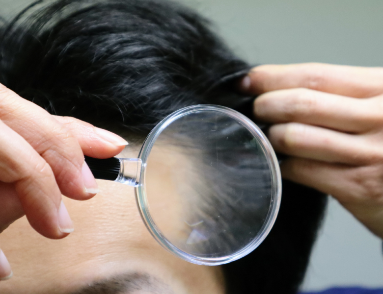 perte de cheveux homme