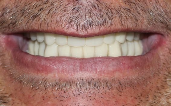 sourire Jérôme après