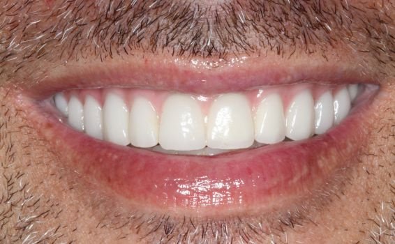 sourire Julien après