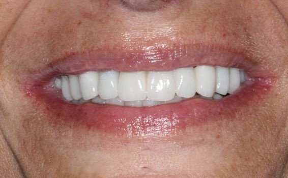 sourire Sophie après