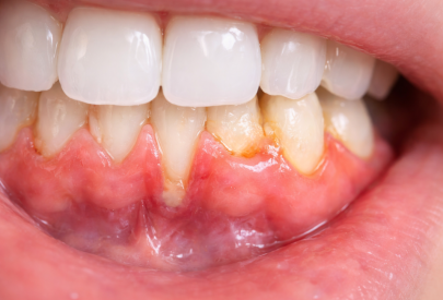 photo d'un déchaussement dentaire