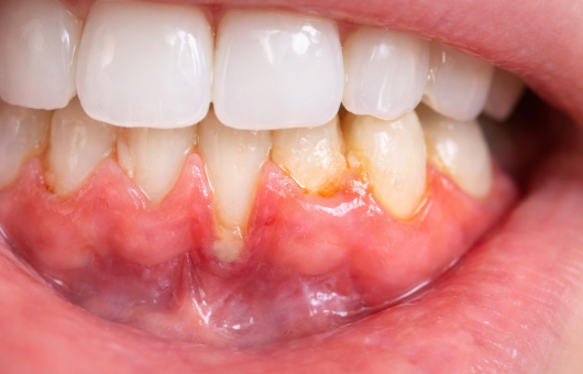 photo d'un déchaussement dentaire