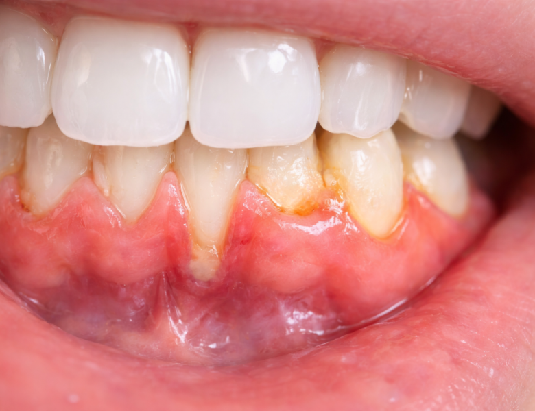 photo d'un déchaussement dentaire