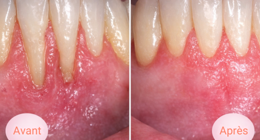 avant après traitement déchaussement des dents