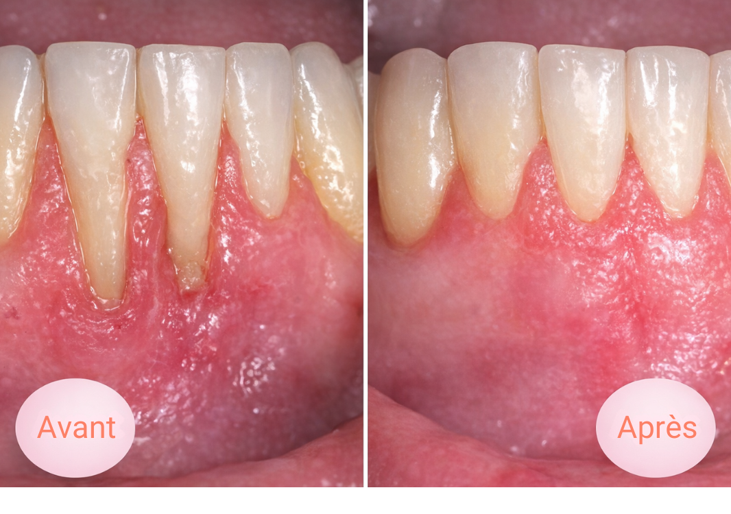 Comment soigner un dchaussement des dents ? Solutions et prix
