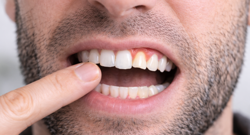 dent du haut qui se déchausse