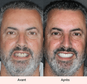 sourire avant après jean manuel