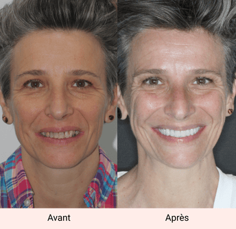 sourire avant après sophie