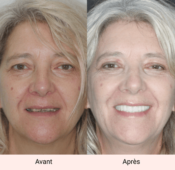 sourire avant après valérie