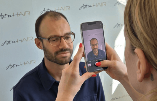 témoignage greffe de cheveux damien