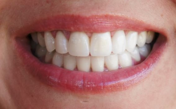 Delphine sourire après