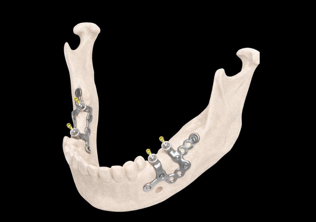 Implants dentaires juxta-osseux