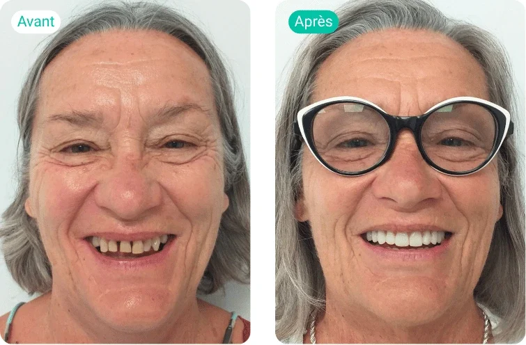 sourire avant après de Marie, patiente accompagnée par Smile Partner pour son dentier fixe à tenerife