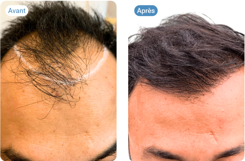 resultat avant apres greffe de cheveux