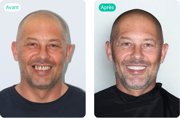 sourire avant après de Julien, patient accompagné par Smile Partner pour ses implants dentaires à Barcelone