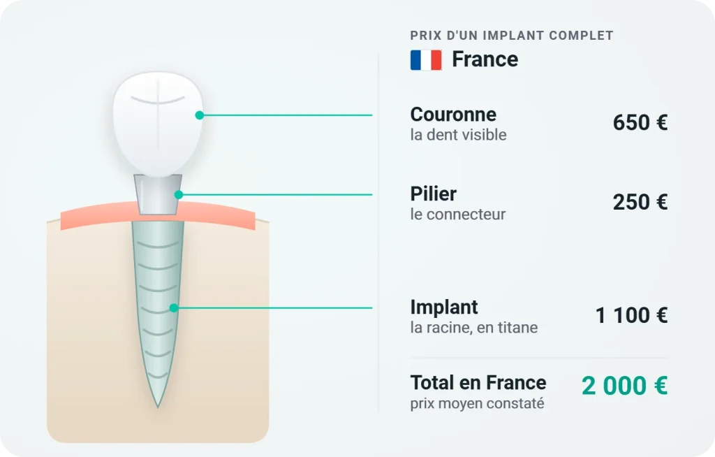 Prix d'un implant dentaire complet en France : couronne 650 €, pilier 250 €, implant 1 100 €, soit 2 000 € au total
