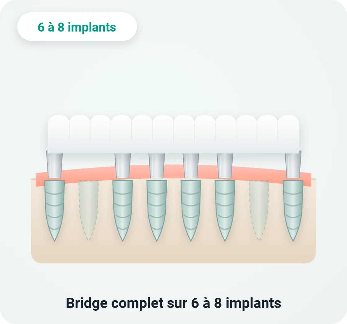 Schéma d'un bridge dentaire complet de 12 dents sur 6 à 8 implants