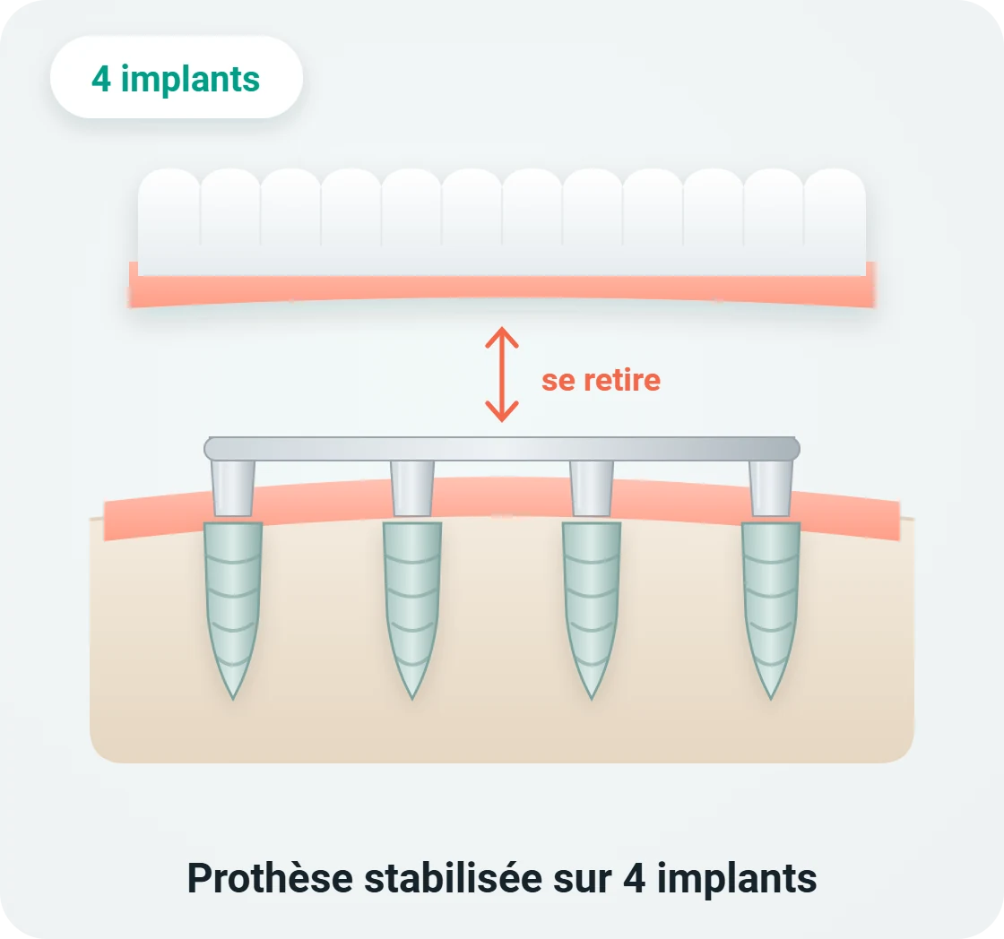 Schéma d'une prothèse dentaire stabilisée sur 4 implants, amovible pour l'entretien