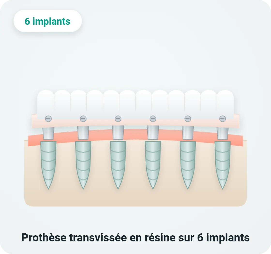 Schéma d'une prothèse complète transvissée en résine sur 6 implants dentaires