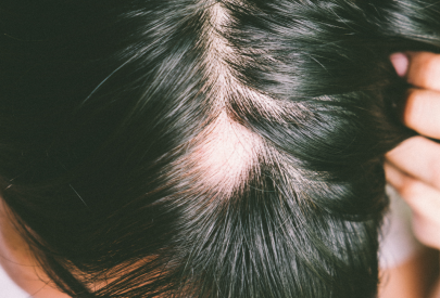 personne qui a une alopecie areata sur le crane, et cherche des réponses et solutions