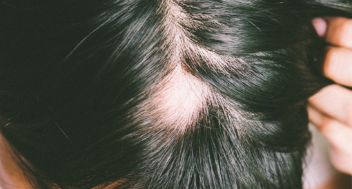 personne qui a une alopecie areata sur le crane, et cherche des réponses et solutions