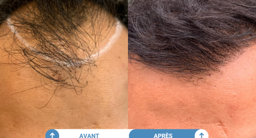 avant apres d'une greffe de cheveux réaisée dans notre clinique partenaire parisienne