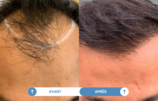 avant apres d'une greffe de cheveux réaisée dans notre clinique partenaire parisienne
