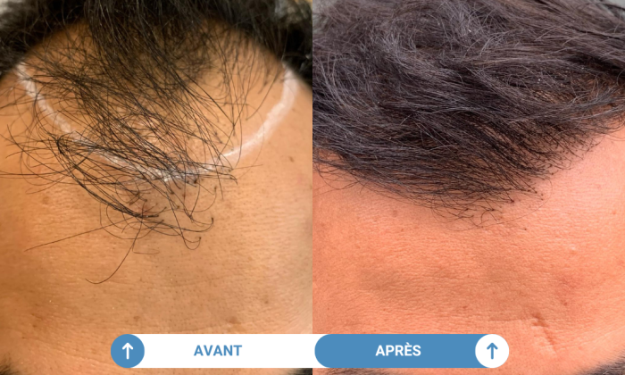 avant apres d'une greffe de cheveux réaisée dans notre clinique partenaire parisienne