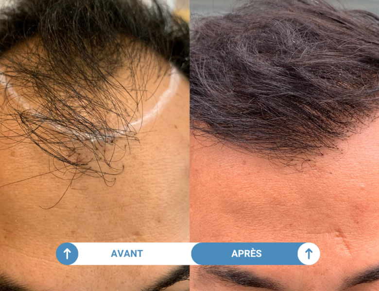 avant apres d'une greffe de cheveux réaisée dans notre clinique partenaire parisienne
