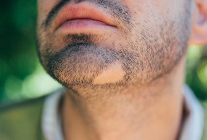 homme faisant face à un problème de pelade au niveau de sa barbe