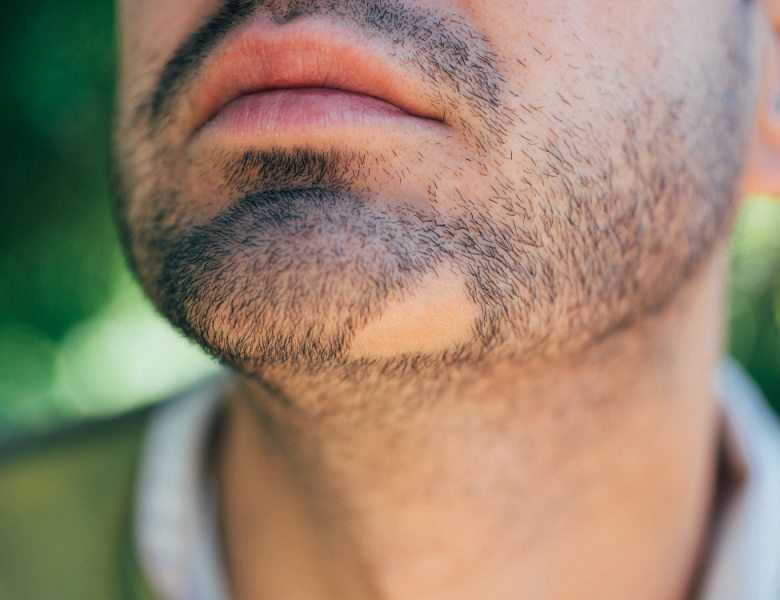 homme faisant face à un problème de pelade au niveau de sa barbe