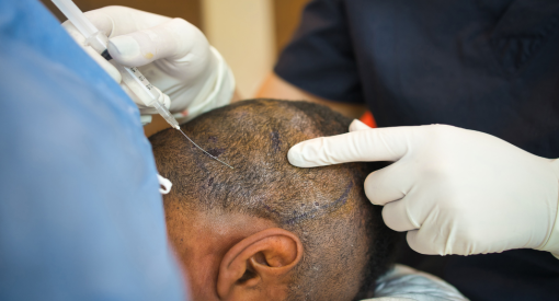 traitement mesotherapie ou led pour la perte de cheveux