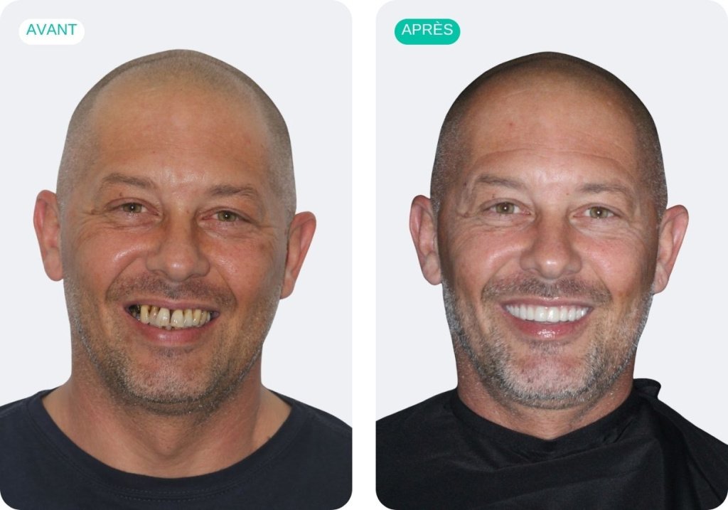Julien, 42 ans, avant et après une réhabilitation dentaire complète sur implants