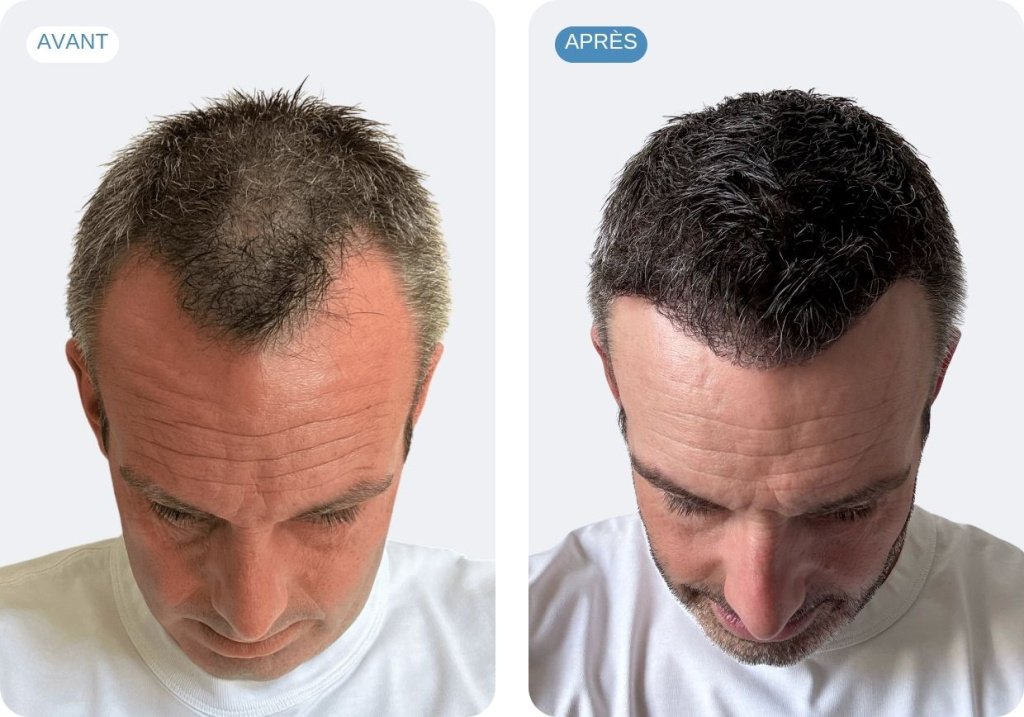 Julien L., 40 ans, avant et après une greffe de cheveux au niveau des golfes et du dessus