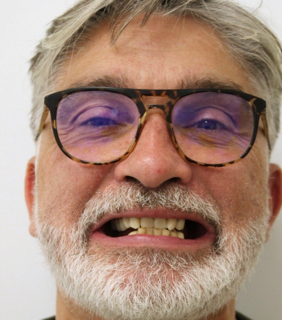 Jean-Michel, 55 ans, avant ses soins : dents usées et manquantes