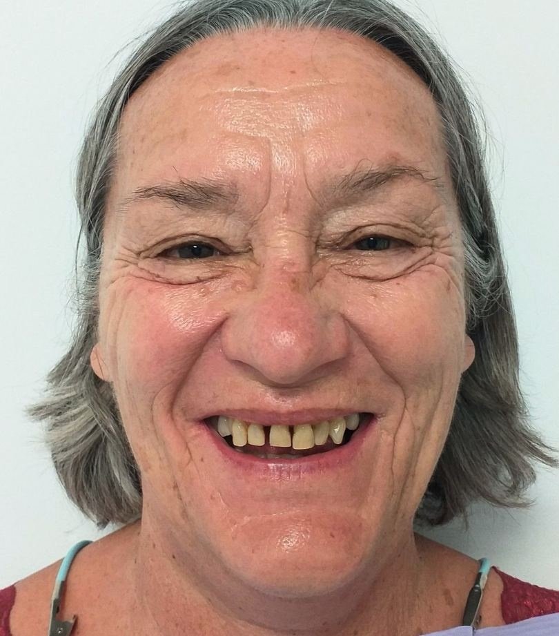 Marie avant ses soins : dents fragilisées par une parodontite