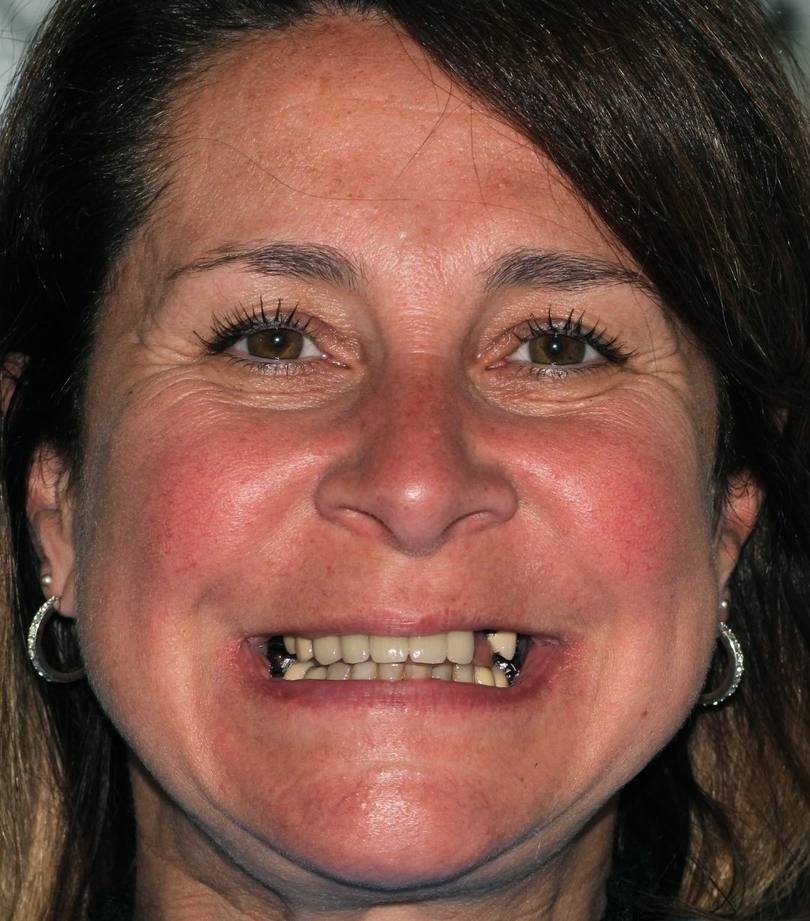 Véronique avant ses soins dentaires